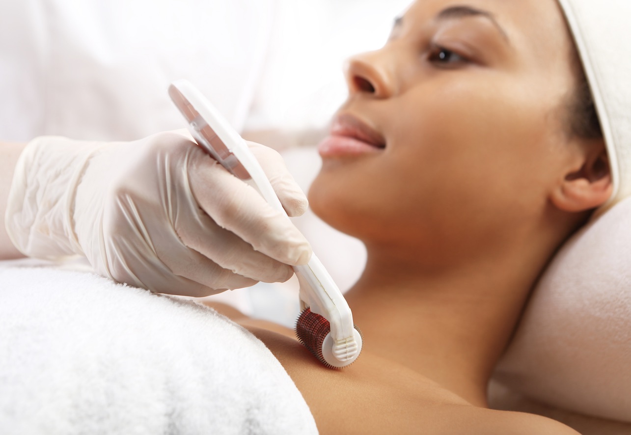 Microneedling treatment